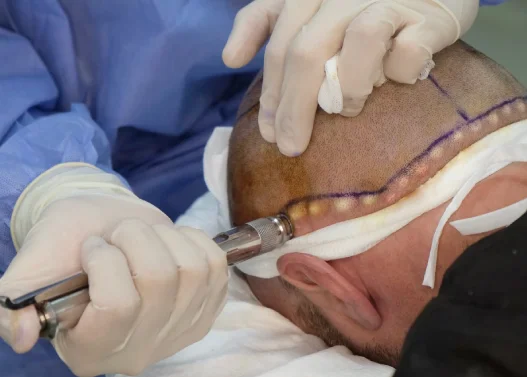 Ist Nadellose Anästhesie Bei Der Haartransplantation Betäubung Möglich? 3 needle free anesthesia hair transplant cost