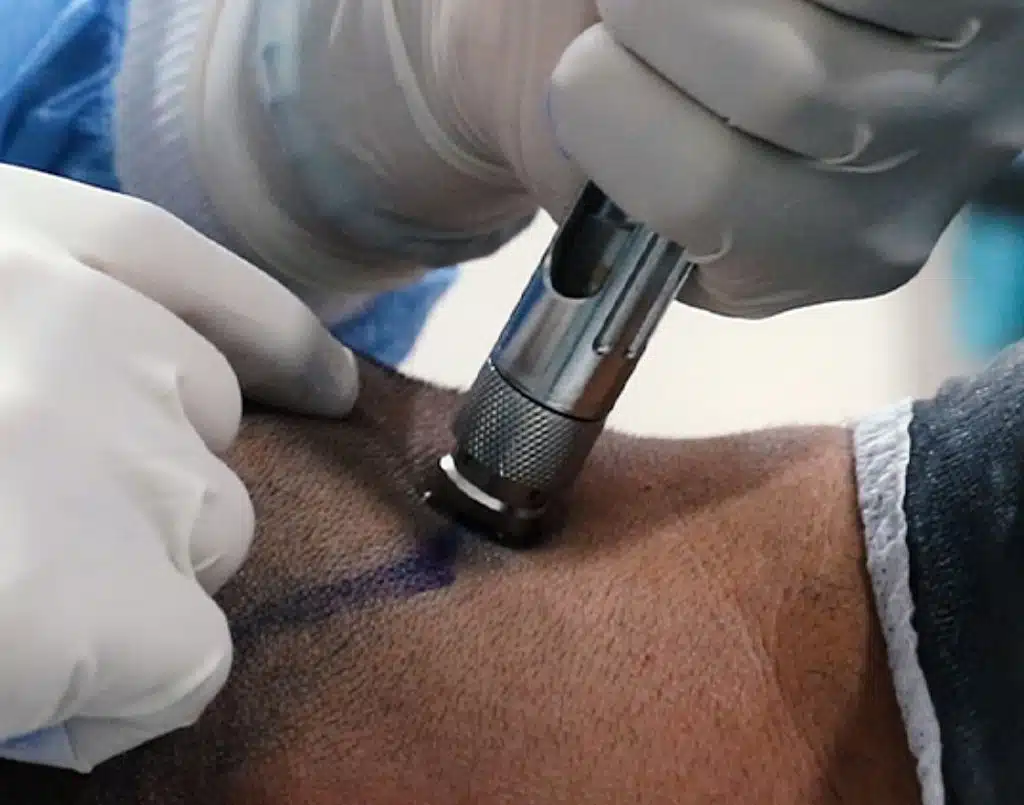 Ist Nadellose Anästhesie Bei Der Haartransplantation Betäubung Möglich? 2 needle free anesthesia hair transplant