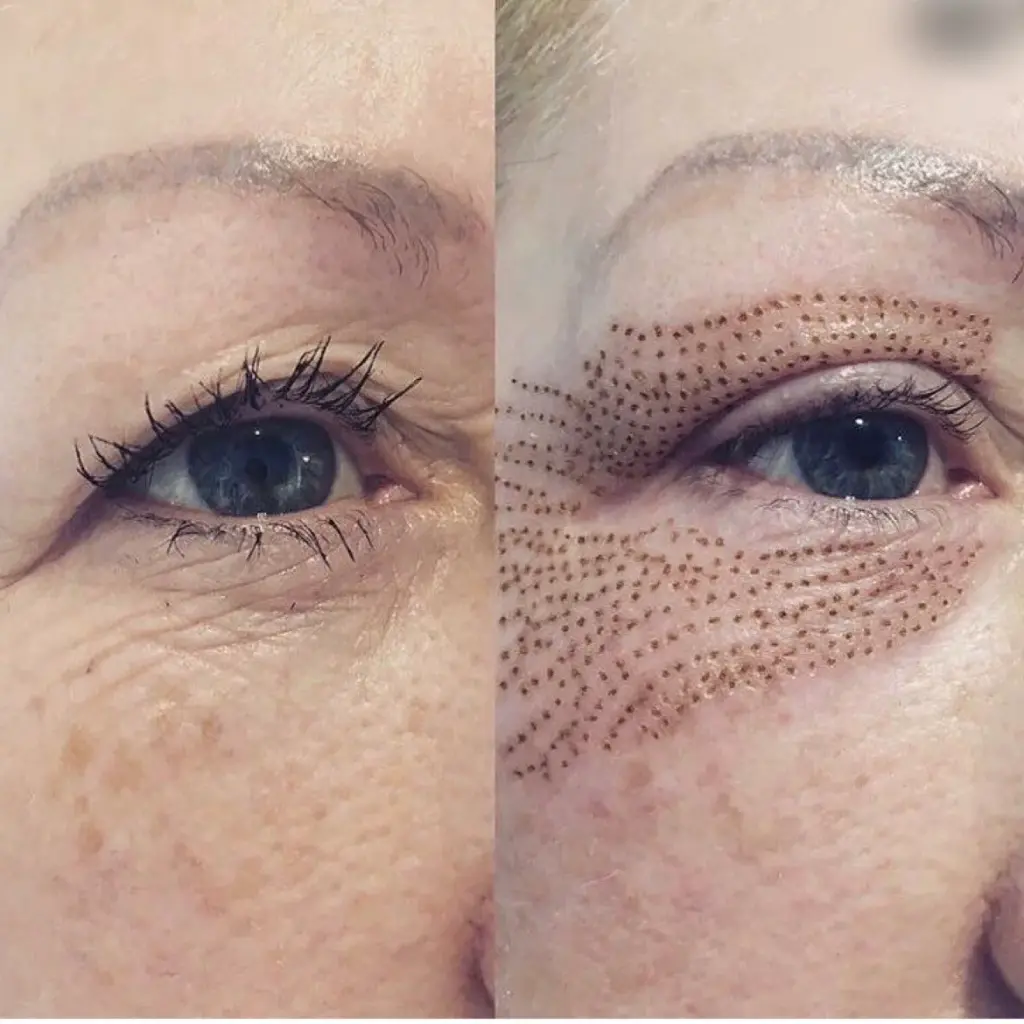 non surgical eyelid lift cost