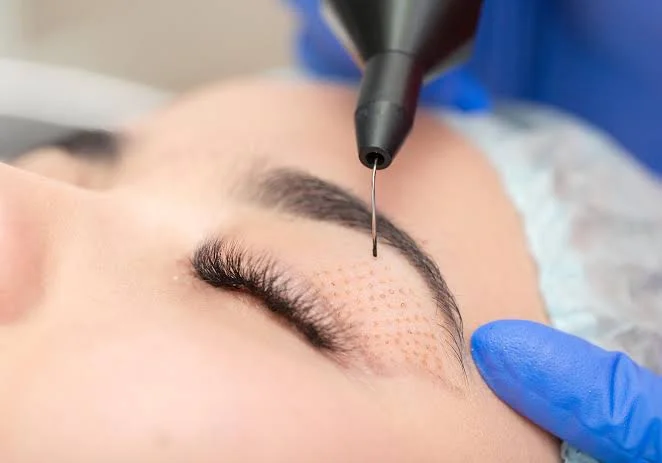 non surgical eyelid lift treatment