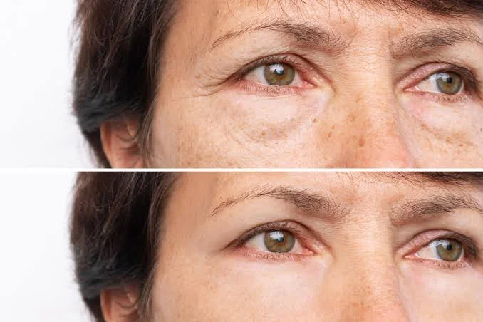 non surgical eyelid lift