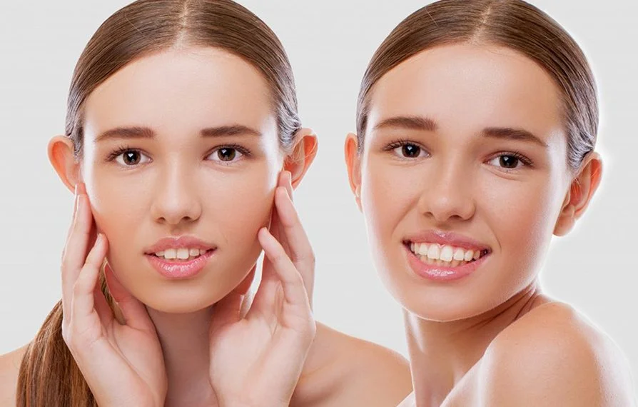Otoplasty Surgery: Ear Pinning, Recovery, Cost & Before and After 3 otoplasty before after