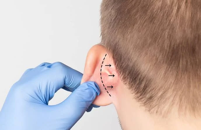 Otoplasty Surgery: Ear Pinning, Recovery, Cost & Before and After 2 otoplasty