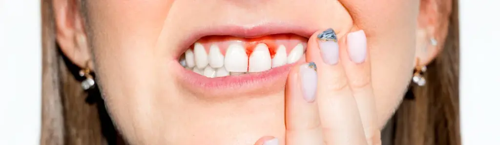 peri implantitis