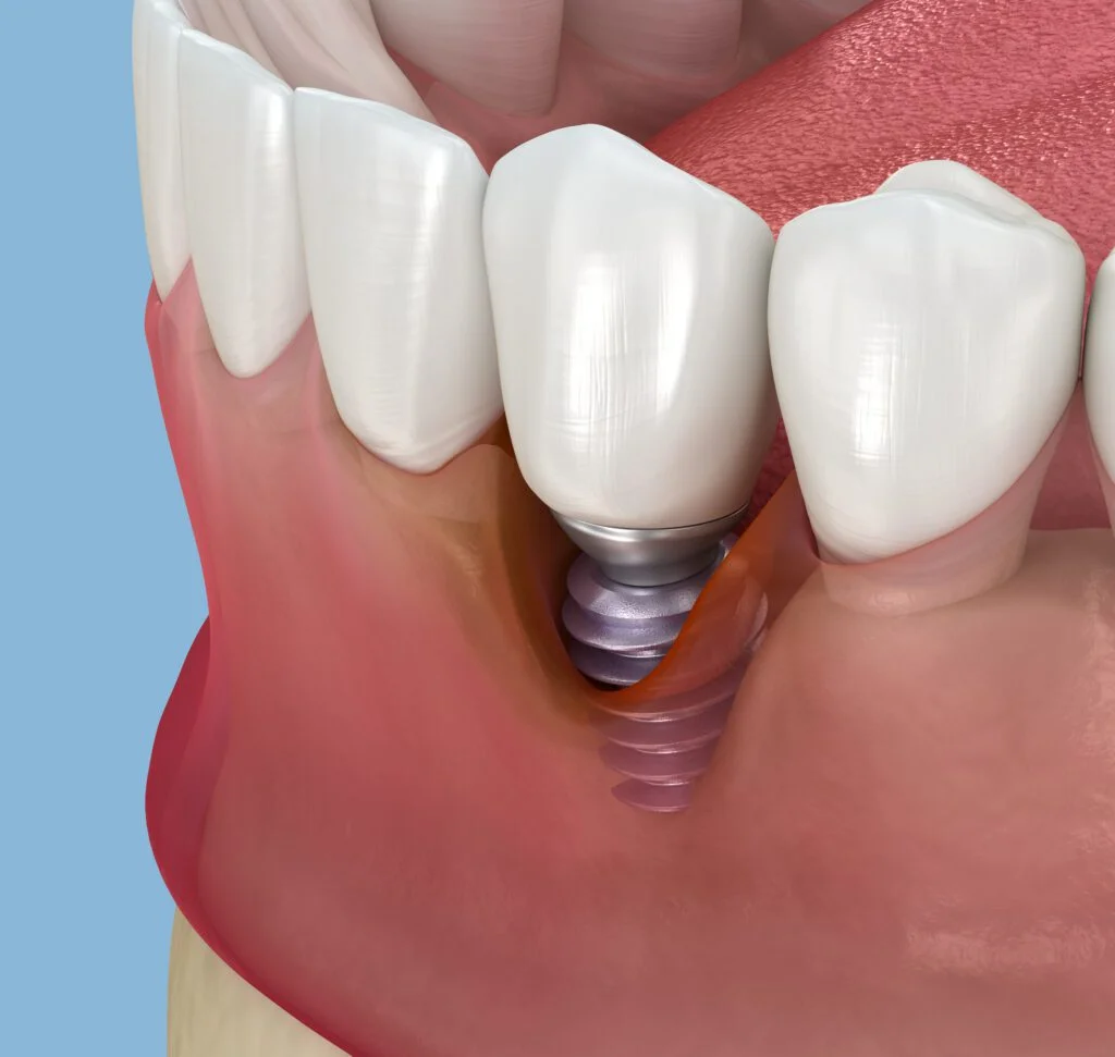 peri-implantitis