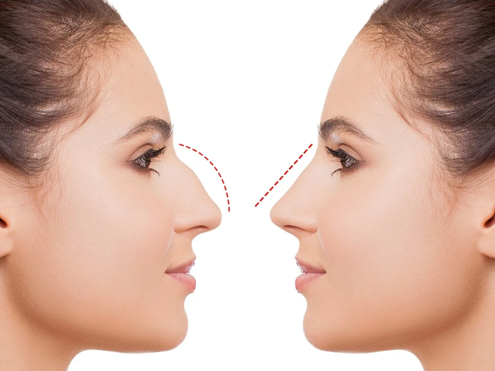 What is Piezo Rhinoplasty? Ultrasonic Technique, Cost & Recovery 3 piezo rhinoplasty before after