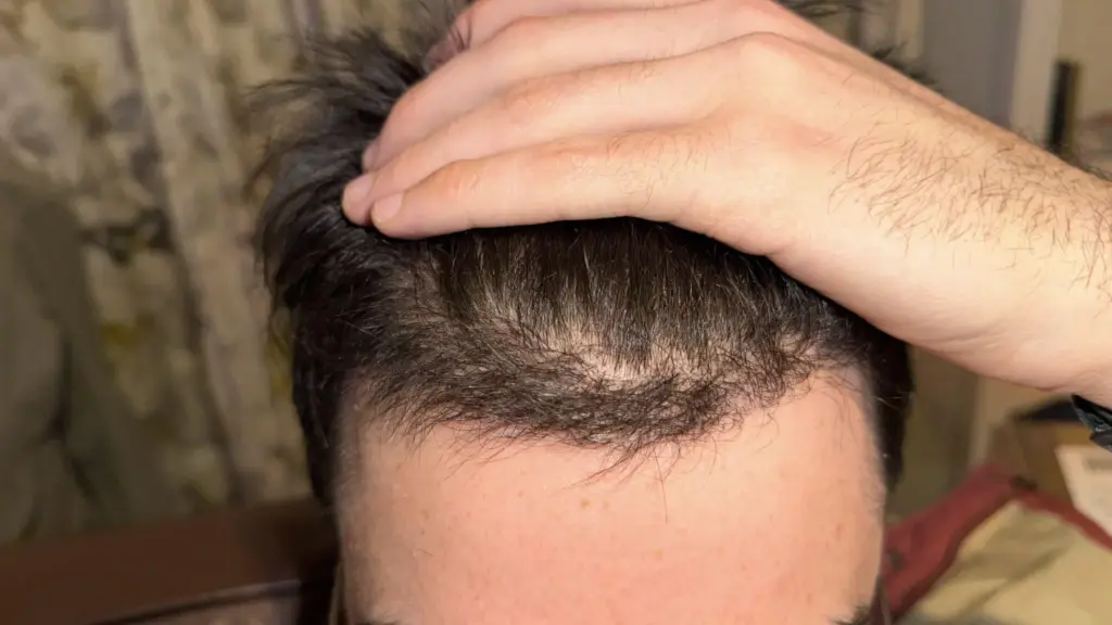 Haartransplantatie met 'Plugs': Herstel van Poppenhaar & Kosten 2 pluggy hair transplant result