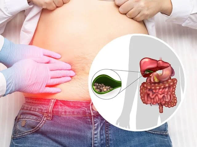 gallstones after bariatric surgery