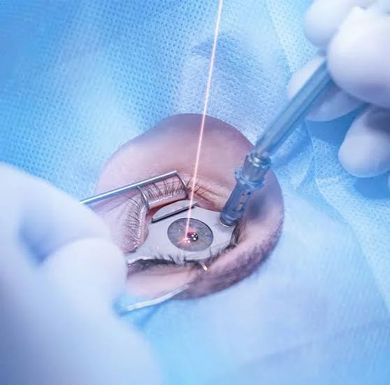 prk surgery cost