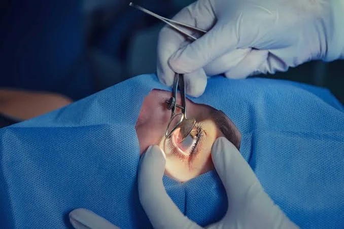 prk surgery
