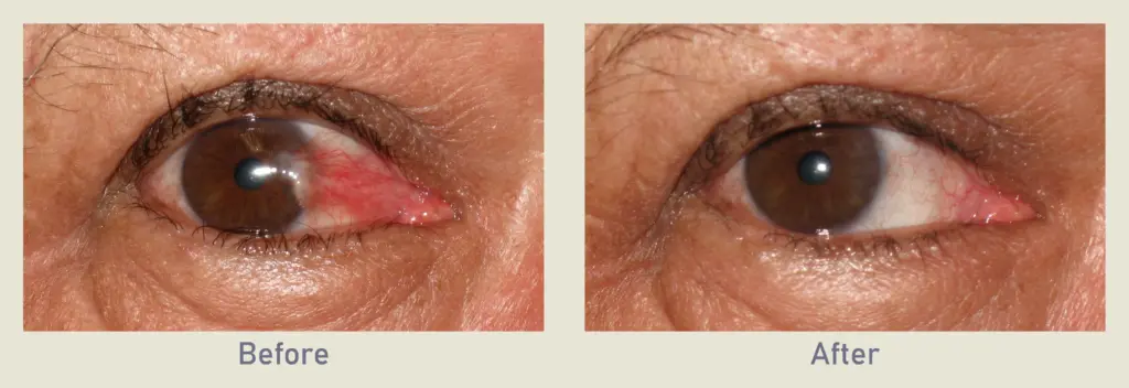 pterygium surgery