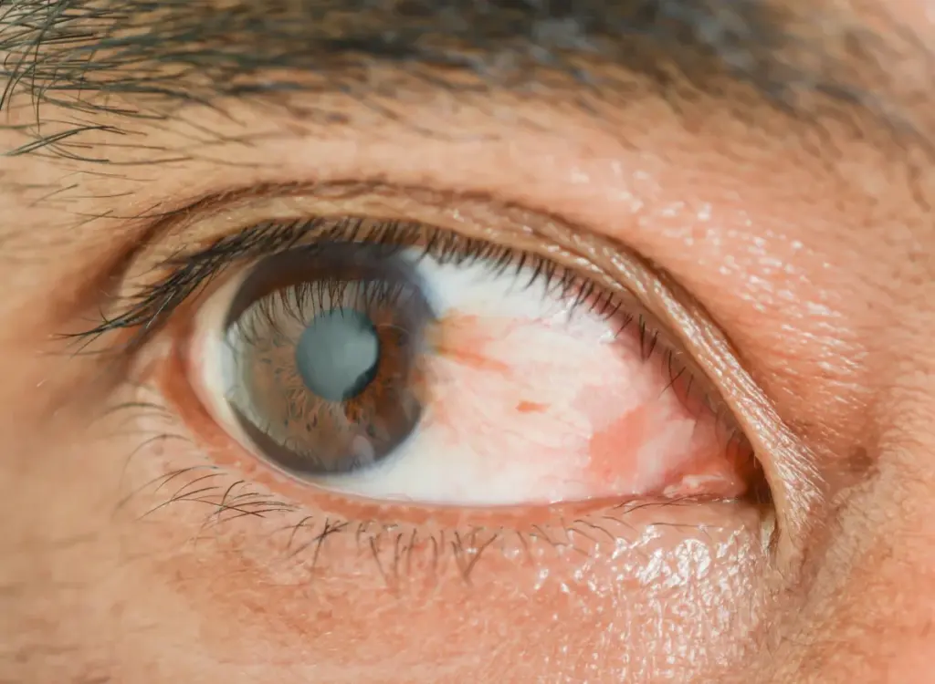 pterygium surgery cost