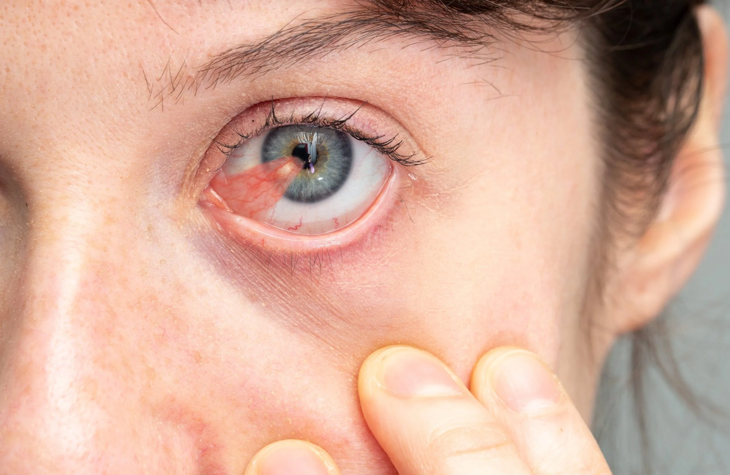 Pterygium-Operation: Autotransplantat, Ablauf, Heilung & Kosten