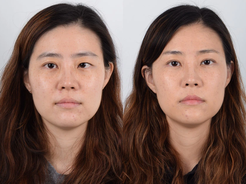 ptosis surgery before after