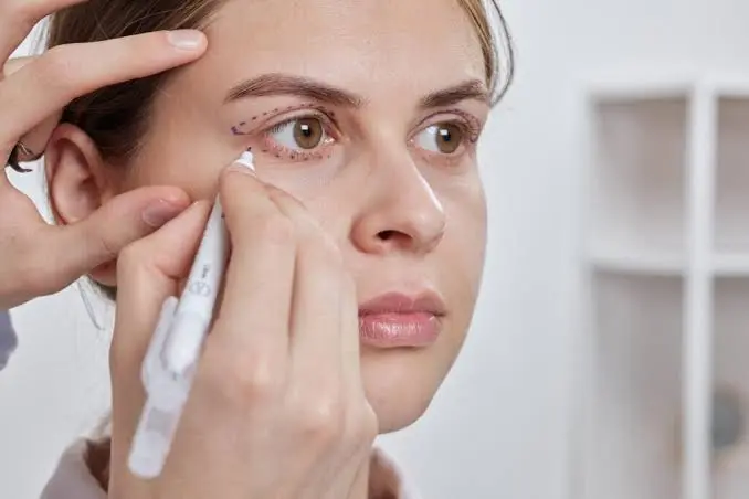 ptosis surgery
