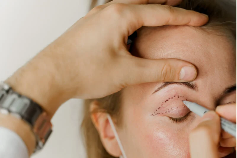 ptosis surgery