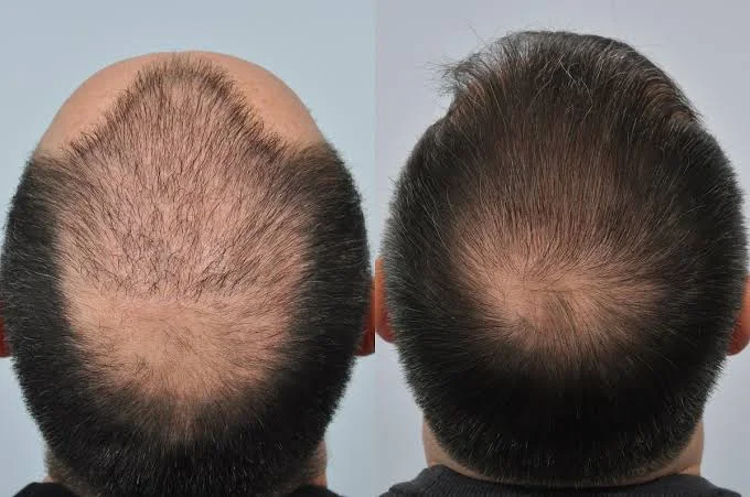 How Is Repair Hair Transplant Procedure Performed? Techniques And Prices 1 repair hair transplant cost