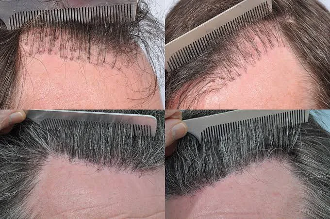 How Is Repair Hair Transplant Procedure Performed? Techniques And Prices 2 repair hair transplant