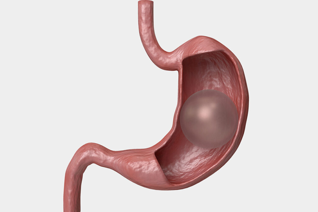 revision after gastric balloon