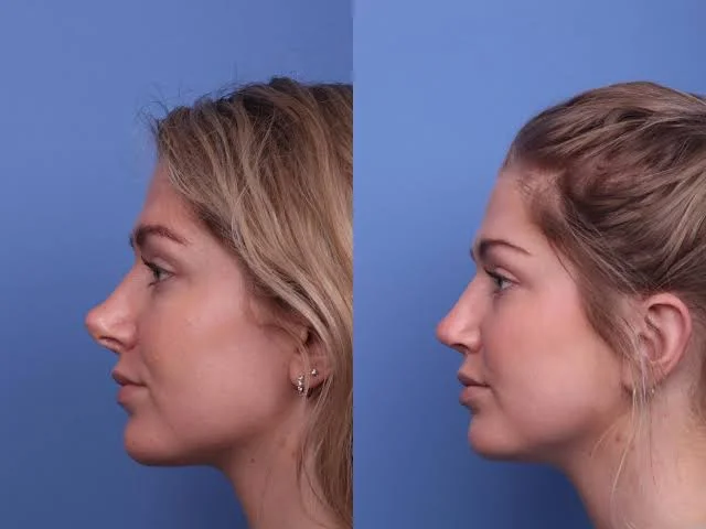 Revizyon Burun Ameliyatı: İyileşme Süreci, Kıkırdak Greftleri, Riskler ve Türkiye'deki Maliyetler 3 revision rhinoplasty before after