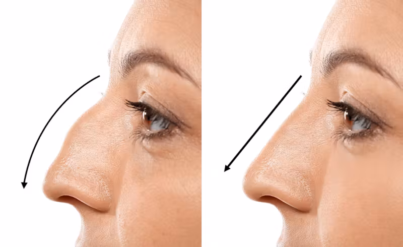 rhinoplasty surgery