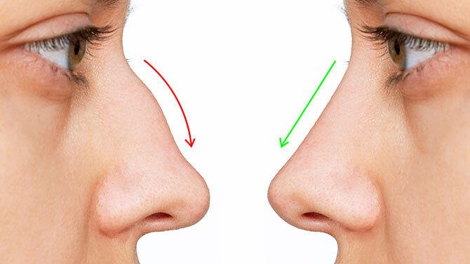 rhinoplasty transformation