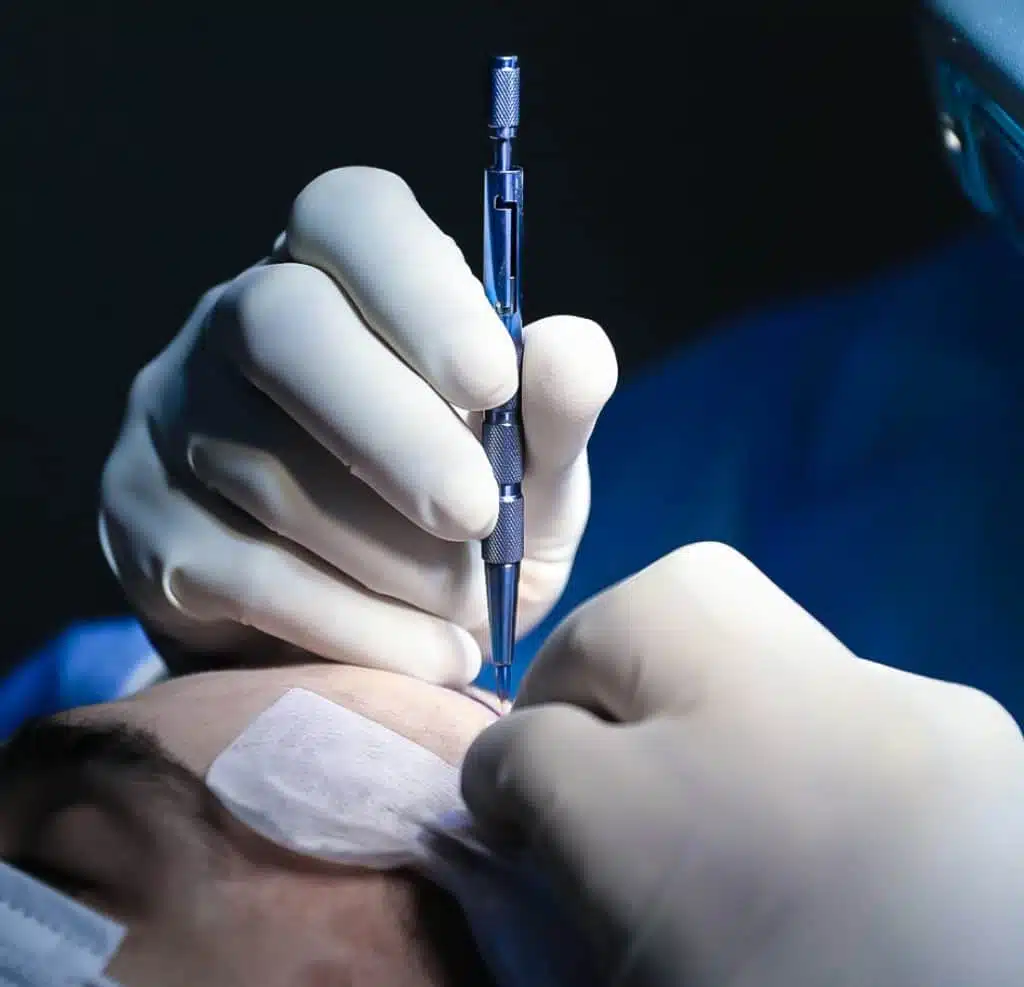 sapphire fue hair transplant