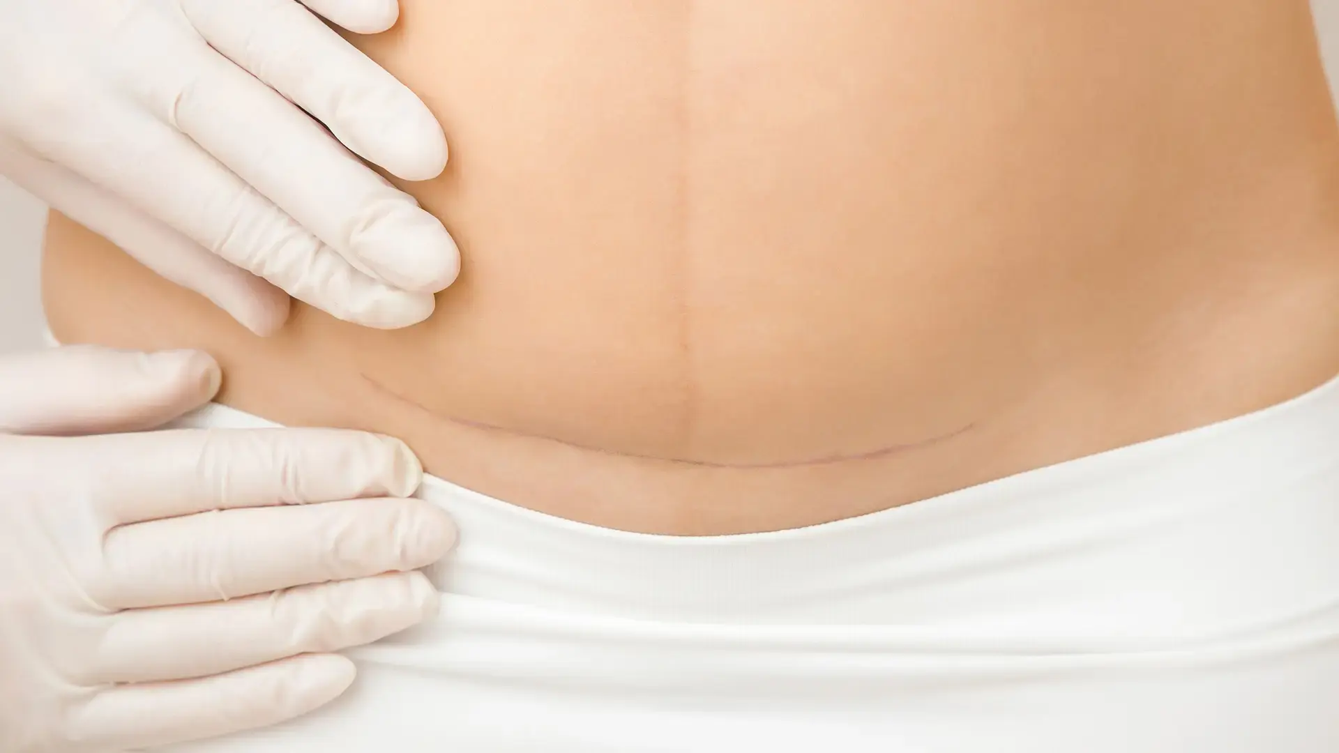 seroma after liposuction