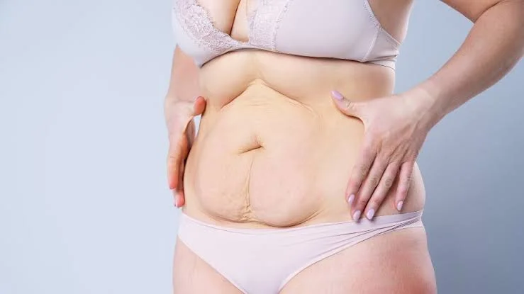 seroma after liposuction 2
