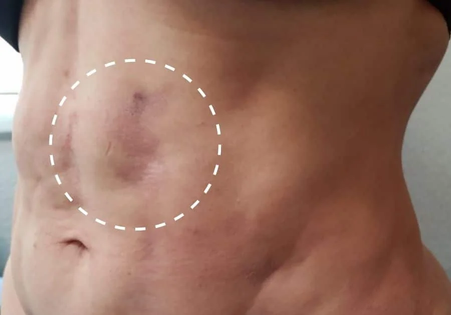 seroma after liposuction