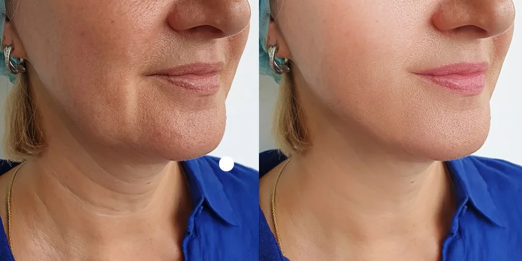 sliding genioplasty before after