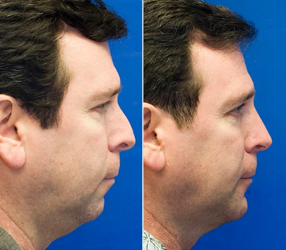 sliding genioplasty