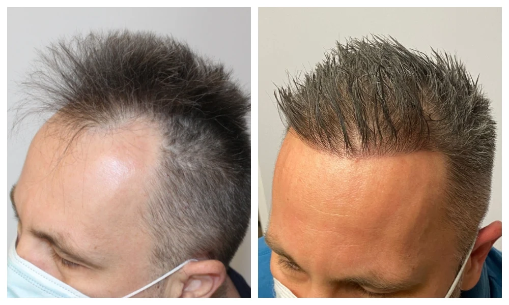 Stamcel Haartransplantatie: Kosten, Resultaten & Turkije Gids 3 stem cell hair transplant before after