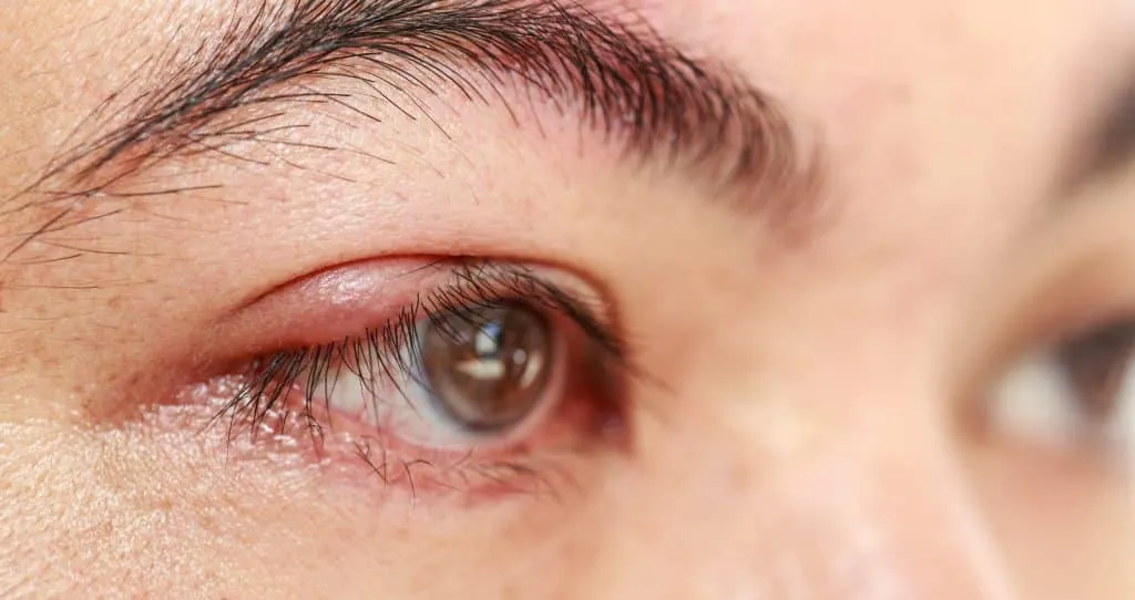 stye disease