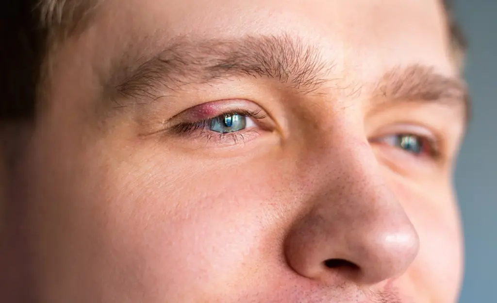 stye disease