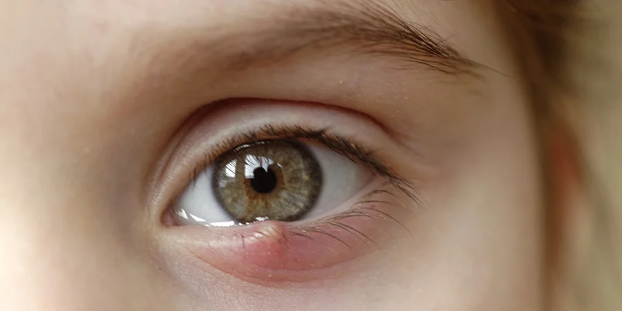stye disease