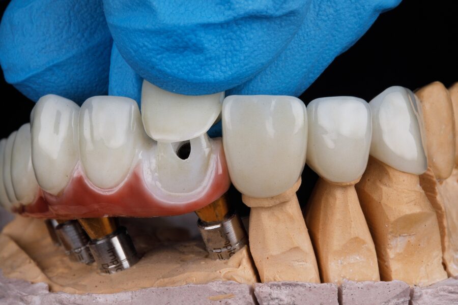 teeth preparation