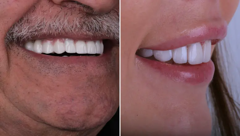Veneers vs Crowns: Price, Durability, Differences & Pros-Cons 3 veneers vs crowns