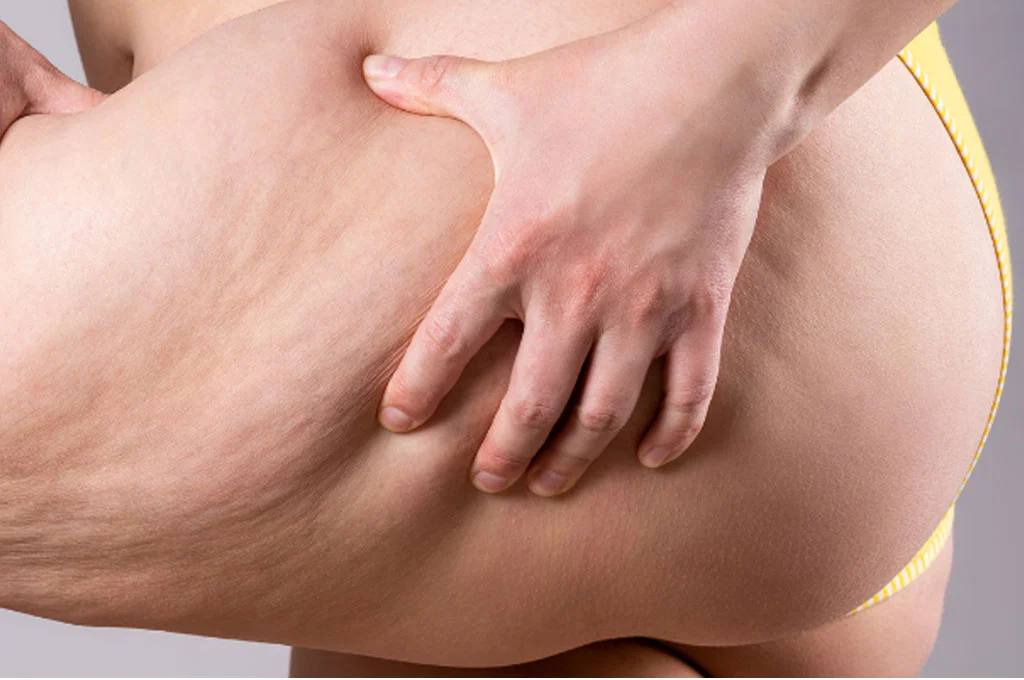 Thigh Lift Surgery: Procedure, Cost and Recovery 3 thigh lift surgery turkey