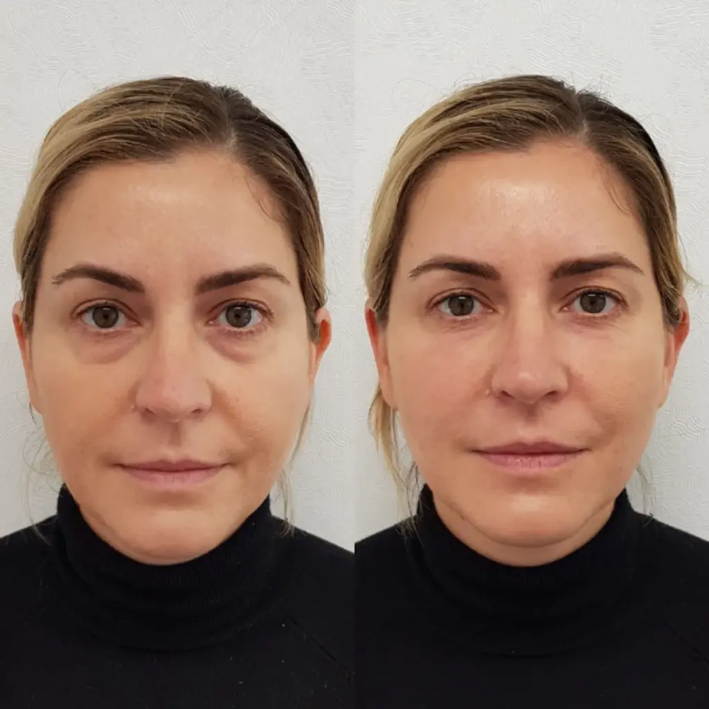 Vermoeidziende Ogen: Oorzaken, Behandelingen & Botox 3 tired looking eyes treatment