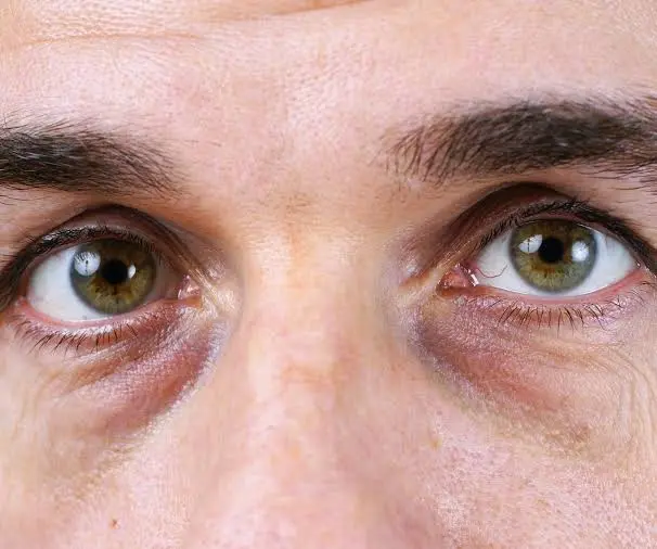 Vermoeidziende Ogen: Oorzaken, Behandelingen & Botox 2 tired looking eyes