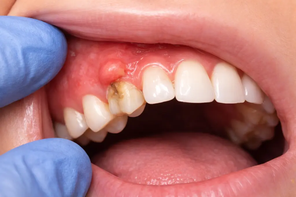 Tooth Abscess: Stages, Symptoms, Treatment, Antibiotics & Relief 1 tooth abscess