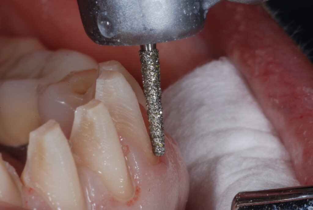 tooth preparation