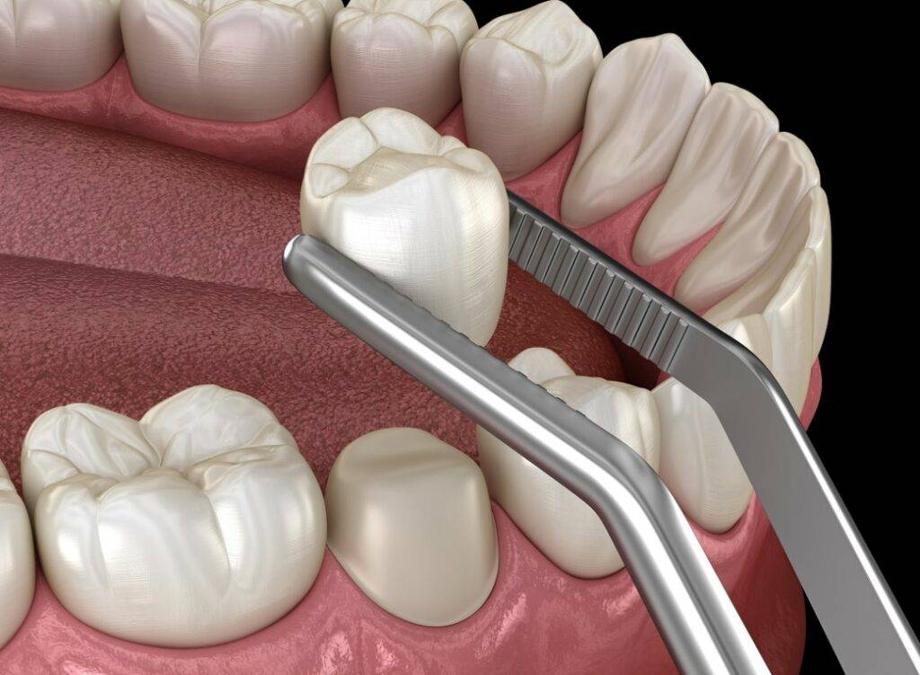 tooth preparation 3d