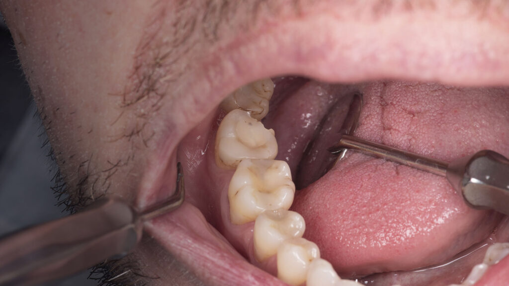 tooth preperation stage