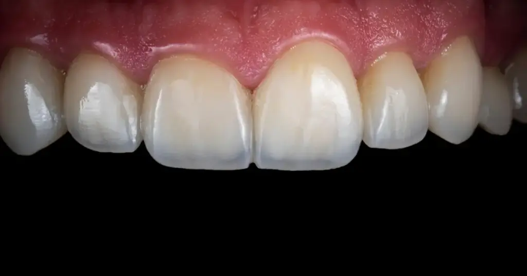 How to Identify Translucent Teeth and 3 Ways to Fix Them 1 translucent teeth