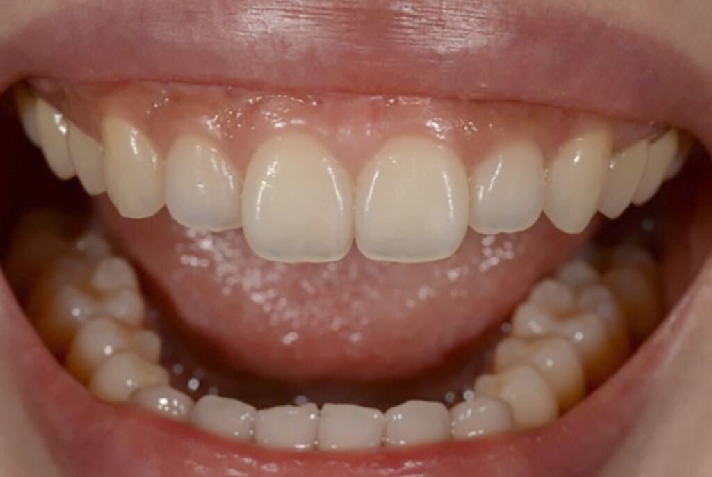 How to Identify Translucent Teeth and 3 Ways to Fix Them 2 translucent teeth