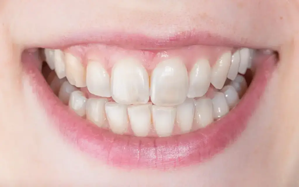 How to Identify Translucent Teeth and 3 Ways to Fix Them 3 translucent tooth
