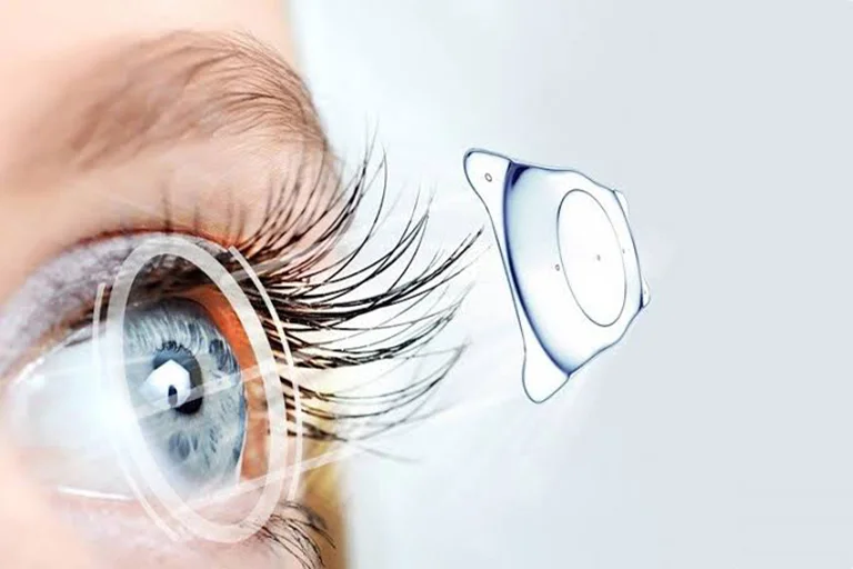 Was sind Trifokallinsen? Leitfaden zu Operation, Kosten und Nebenwirkungen 1 trifocal lenses