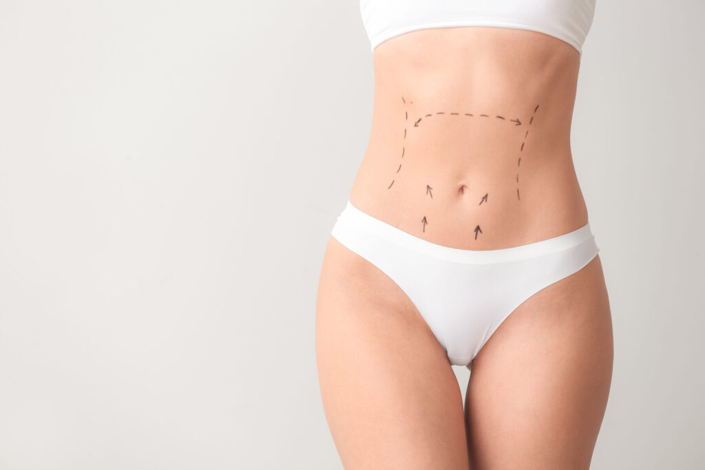 tummy tuck
